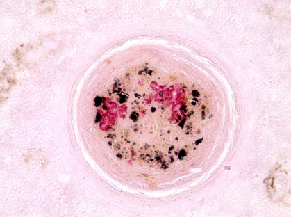 Macrophages surround dead and infective tissue forming a granuloma in a fish with mycobacteria. (courtesy M. Fast)